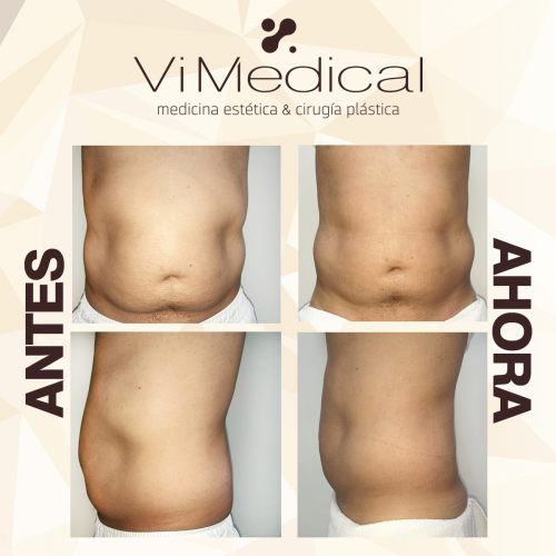 Tratamiento Reductor