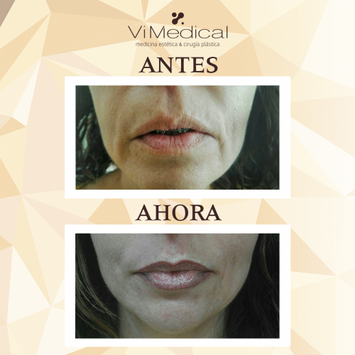 Micropigmentaci�n Labios