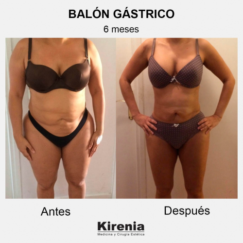 Bal�n g�strico 6 meses frente