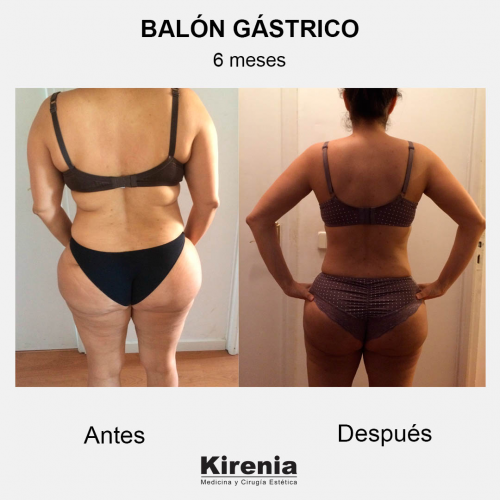 Bal�n g�strico 6 meses