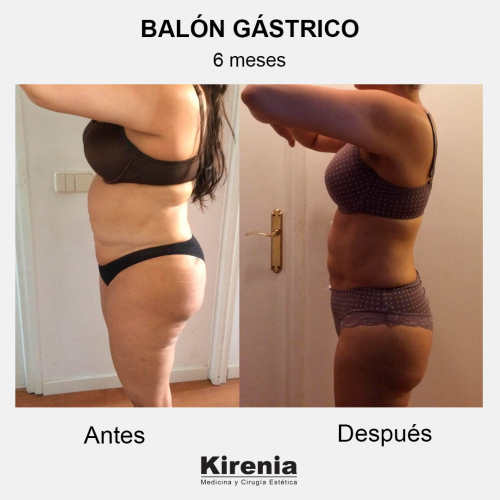 Bal�n g�strico 6 meses lado