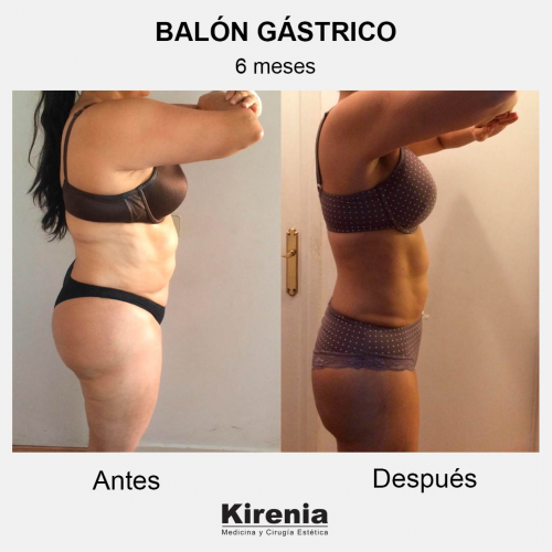 Bal�n g�strico 6 meses perfil