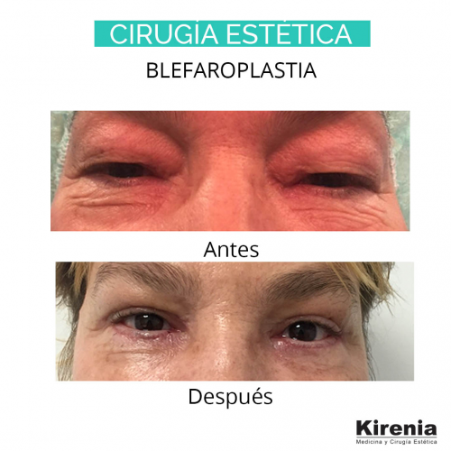 Blefaroplastia