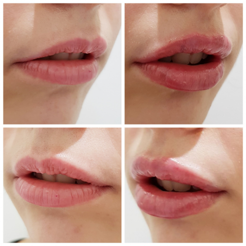 Relleno de labios