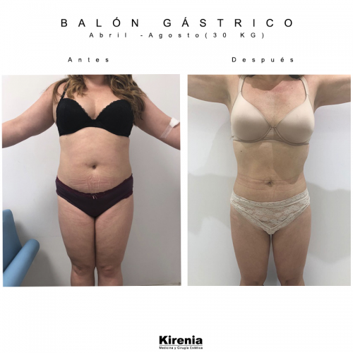 Bal�n g�strico 5 meses