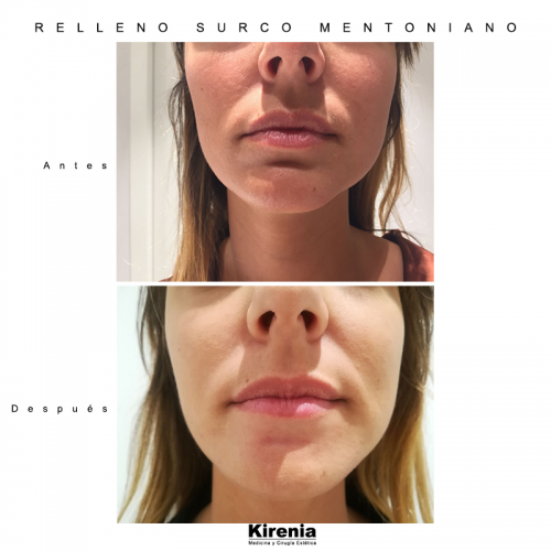 Relleno Surco Mentoniano