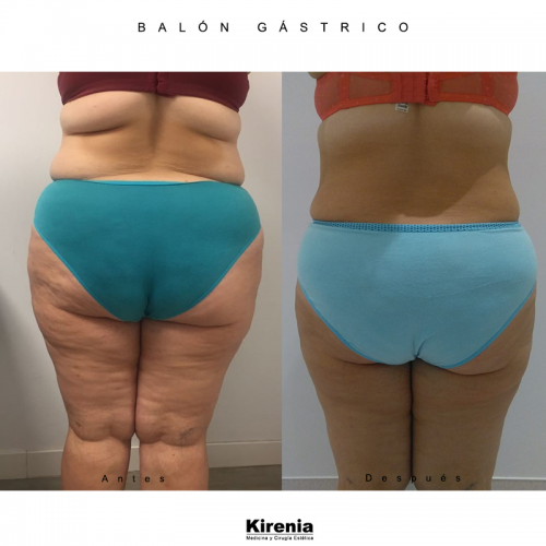 Bal�n g�strico