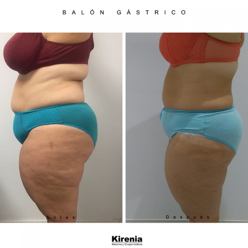 Bal�n g�strico