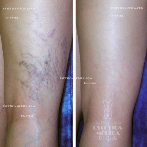 Foto Varices. Dr Oyola