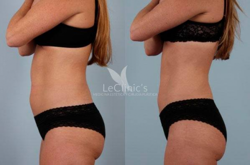 Liposucci�n sin cirug�a Lipolyx