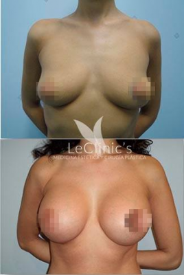 Aumento de pecho