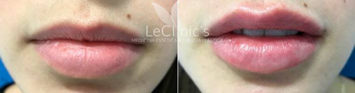 Aumento de labios