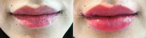 Aumento de labios