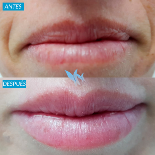 Aumento de labios