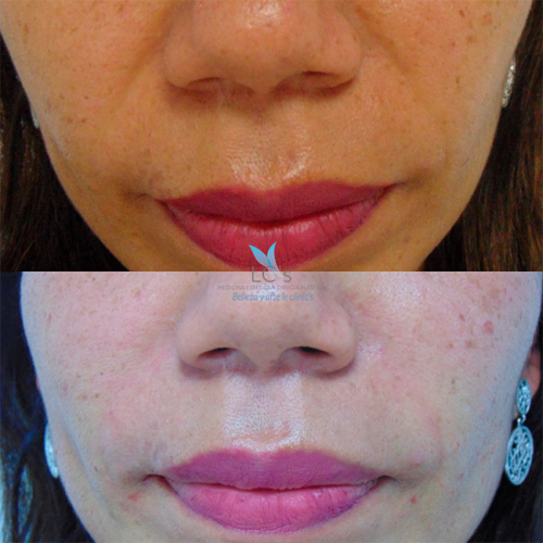 Relleno del Surco Nasogeniano