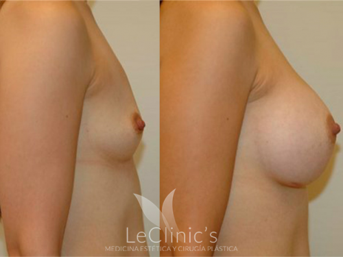 Aumento de pecho