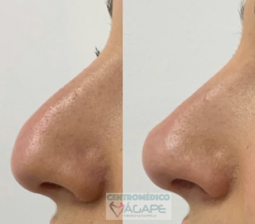 Rinomodelaci�n con �cido hialur�nico