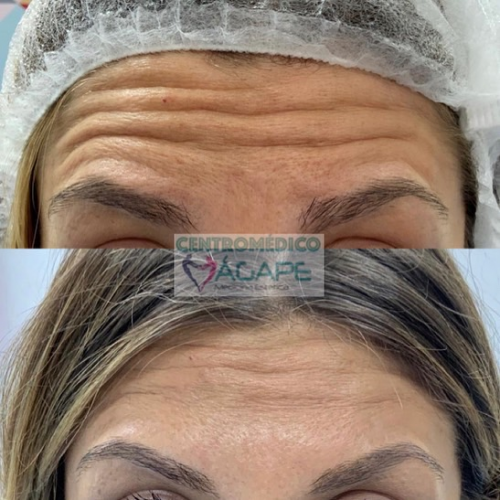 Arrugas de la frente