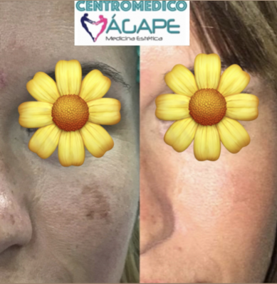 H�per pigmentaci�n o manchas en la piel