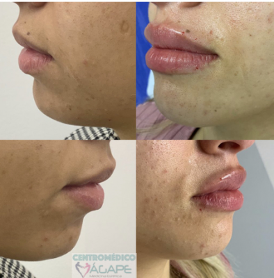 Labios y ment�n