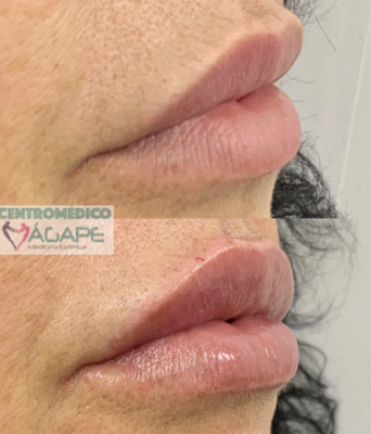 Labios con �cido hialur�nico