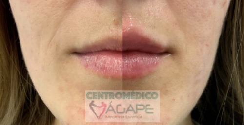 Perfilado e hidrataci�n de labios