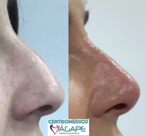 Rinomodelaci�n sin cirug�a