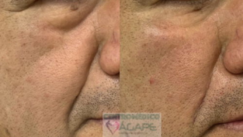 Correcci�n de ojeras