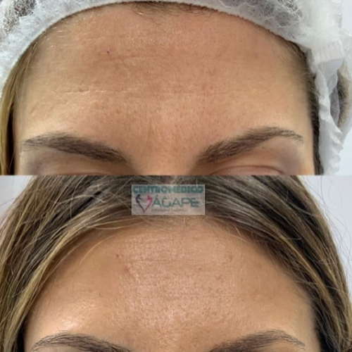 Piel luminosa y arrugas corregidas