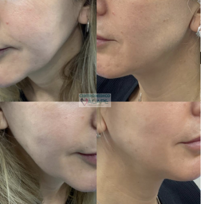 Armonizaci�n facial