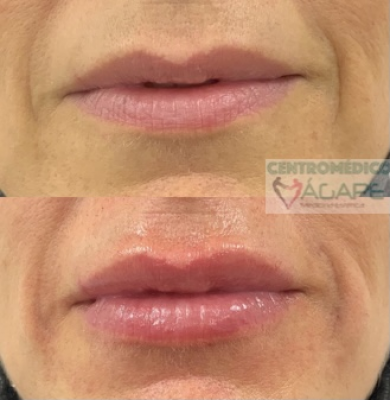 Hidrataci�n de labios con �cido hialur�nico