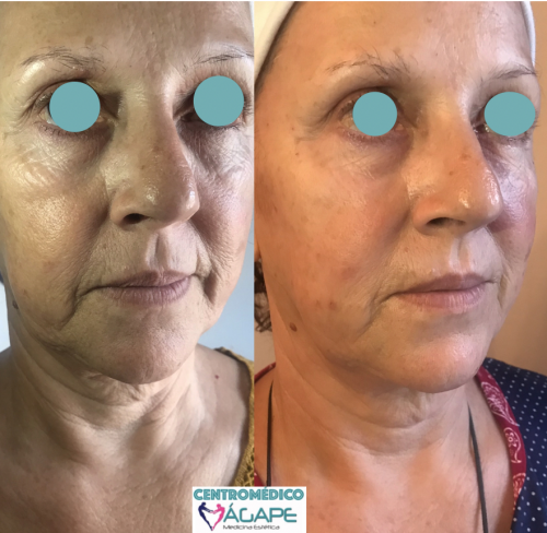 Rejuvenecimiento facial