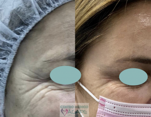 Arrugas del contorno de ojos