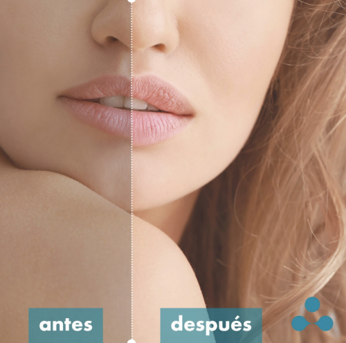 Labios con �cido hialur�nico