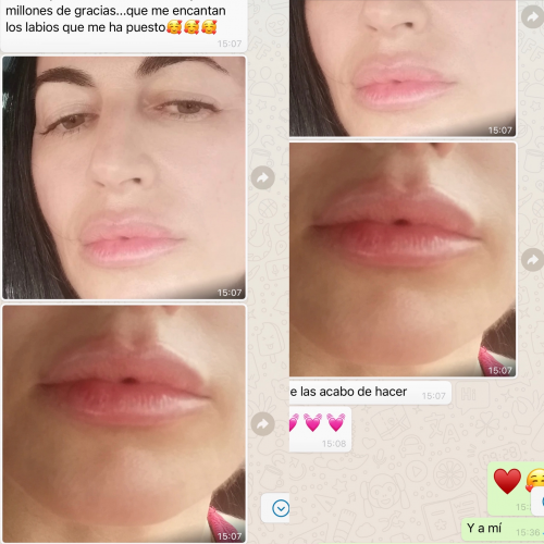 Labios con �cido hialur�nico