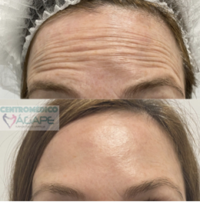 Rejuvenece tu frente