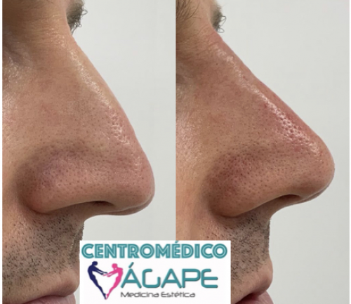 Rinomodelaci�n con �cido hialur�nico