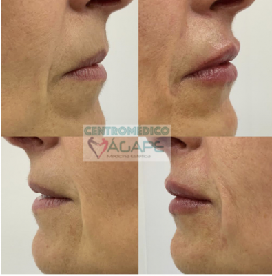 Hidrataci�n de labios