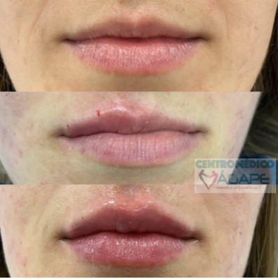 Labios con �cido hialur�nico