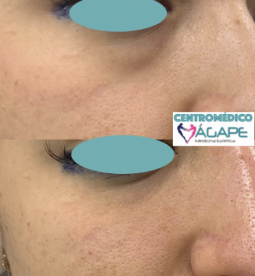 Correcci�n de ojeras