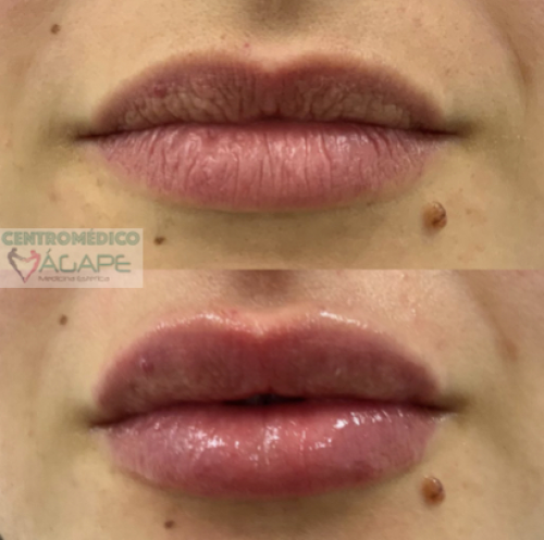 Aumento de labios