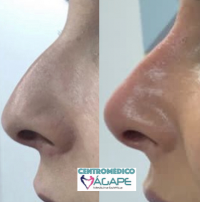 Rinomodelaci�n sin cirug�a