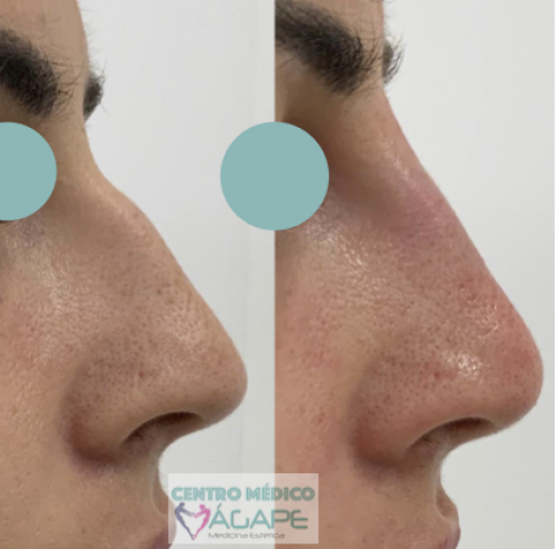 Rinomodelaci�n sin cirug�a