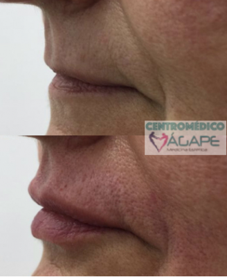 Labios con �cido hialur�nico