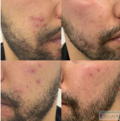 Tratamiento para acn�