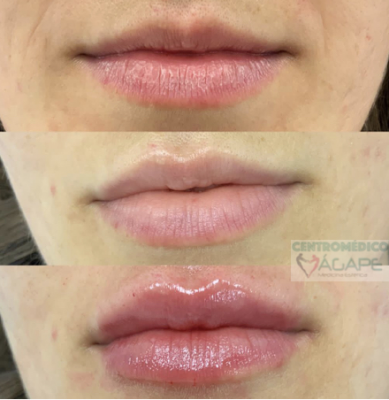 Labios con �cido hialur�nico