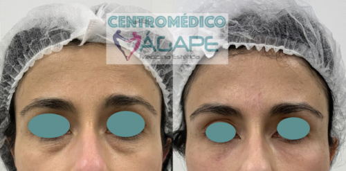 Correcci�n de bolsas