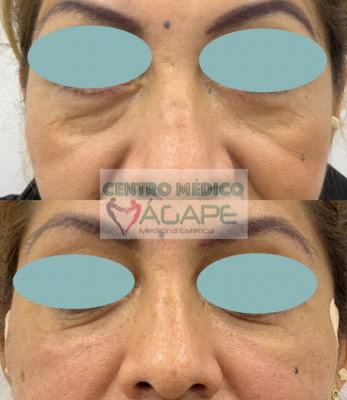 Tratamiento para ojeras