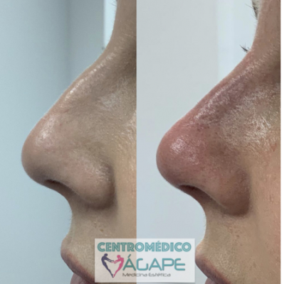 Rinomodelaci�n sin cirug�a