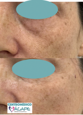 Ojeras con �cido hialur�nico